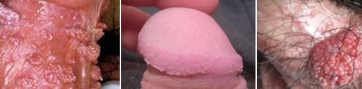 男性尖锐湿疣症状