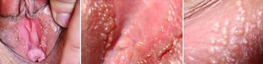 女性尖锐湿疣症状